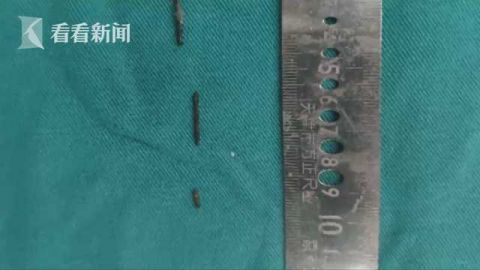 8岁男孩体内五厘米金属异物 :6年家长浑然不知